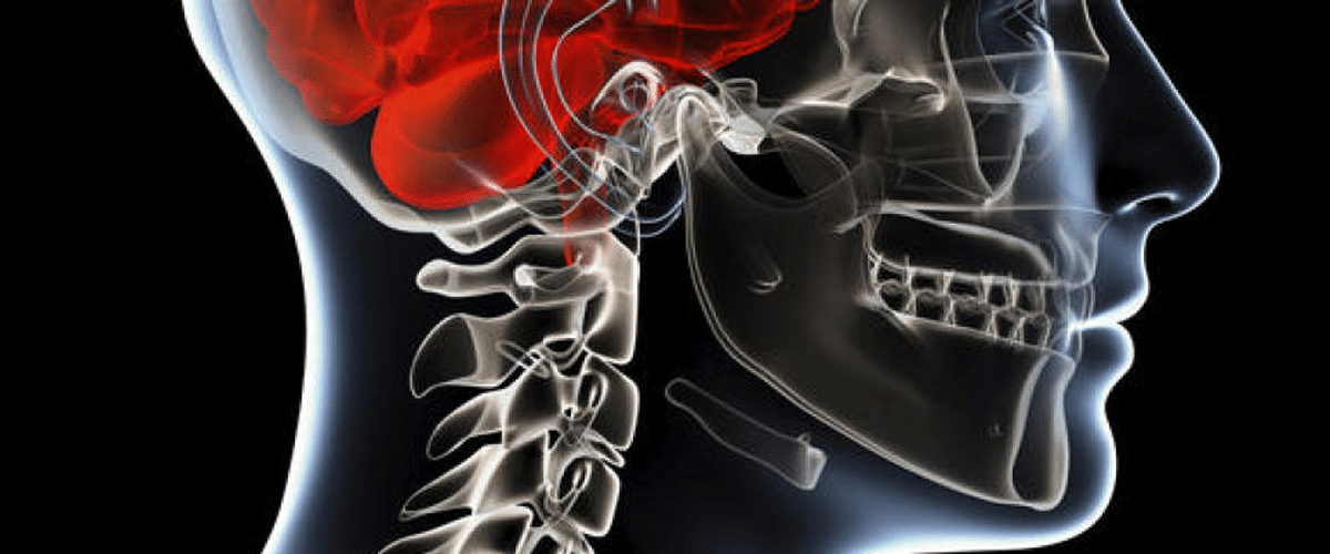 Meningiomas tipos y síntomas