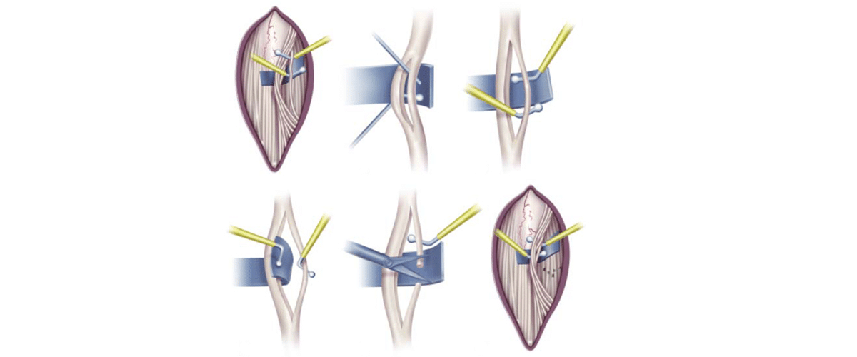 Qué es la rizotomía dorsal selectiva